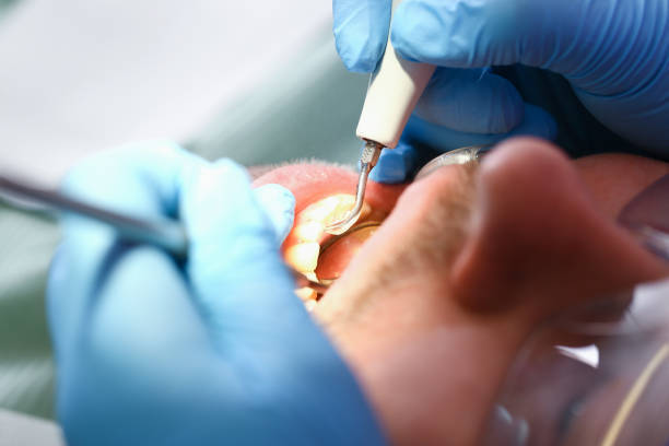 Best Dental Abscess Treatment in Grosse Pointe, MI