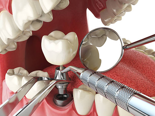 Best Emergency Wisdom Tooth Extraction in Grosse Pointe, MI